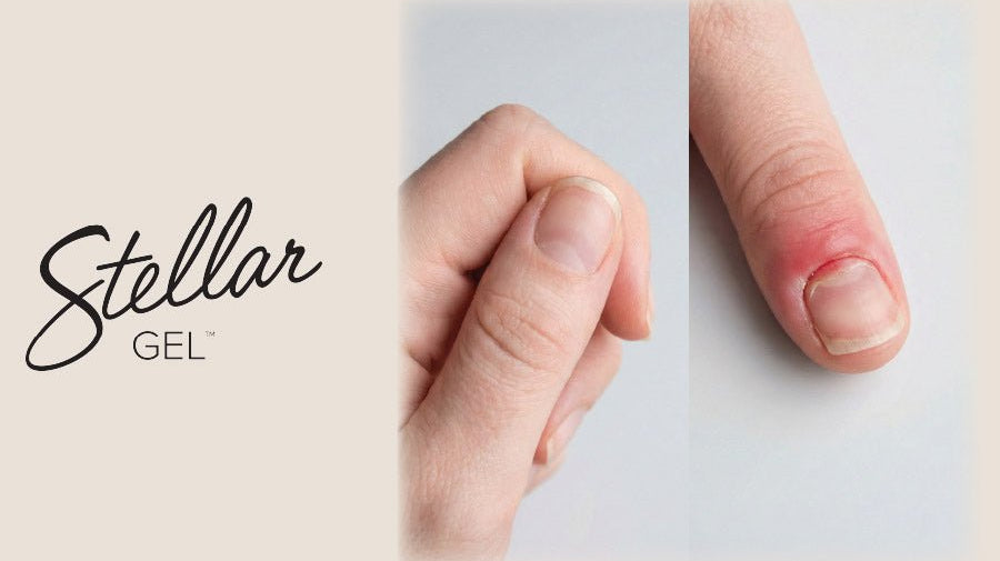 Onycholysis vs. Allergy: How to Spot the Difference - Stellar Gel™